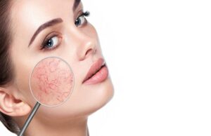 Rosacea