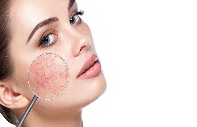 Understanding Rosacea and M22 Photon Rejuvenation